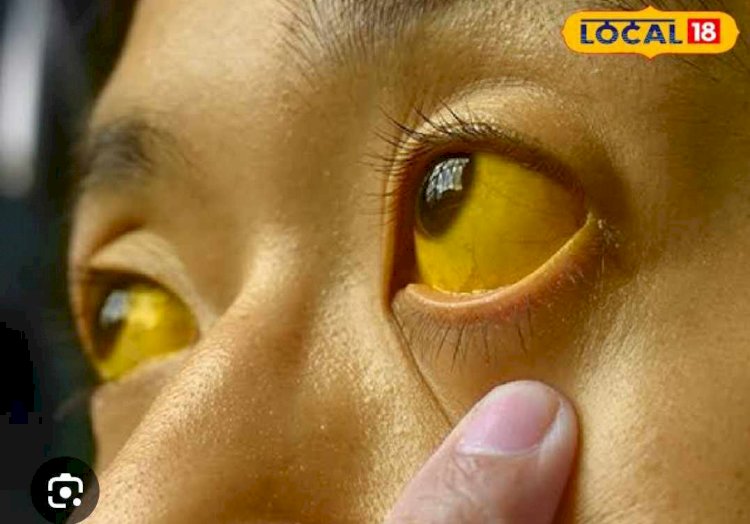 সিলেটে জন্ডিসের প্রাদুর্ভাব: জনস্বাস্থ্য হুমকির মুখে 